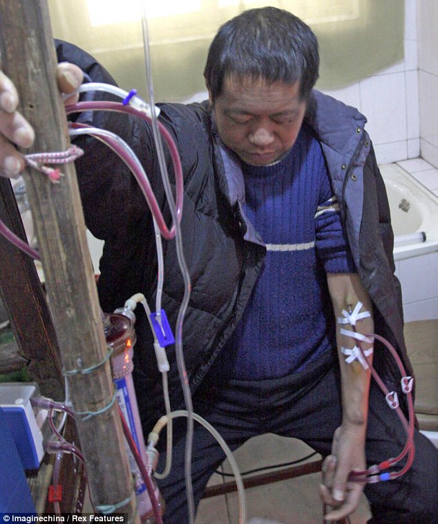 Chinese man makes his own Dialysis Machine to keep himself Alive